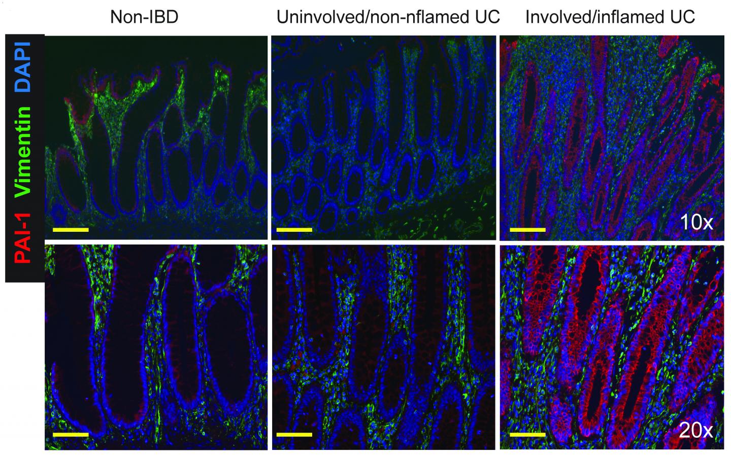 Key Genetic Component May Be Linked to More Aggressive Cases of Inflammatory Bowel Disease (1 of 2)