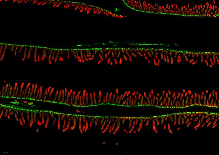 Gut bacteria linked to malnutrition