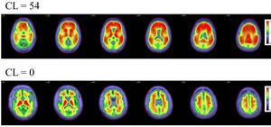 Blood Test Shows Obesity Speeds Alzheimer’s Development
