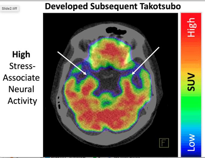 Stressed brain linked to broken heart