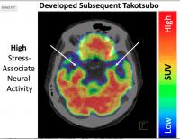 Stressed brain linked to broken heart