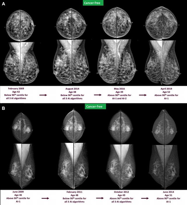 Full-field digital mammograms show craniocaudal (top) and mediolateral (bottom) views of the left and right breast.