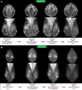 Full-field digital mammograms show craniocaudal (top) and mediolateral (bottom) views of the left and right breast.
