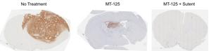 MT-125 and Sutent synergize to attack brain tumors