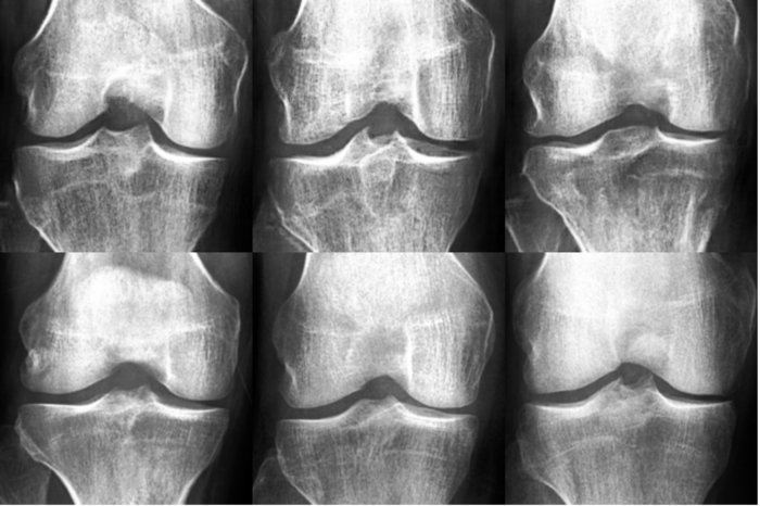 Deep fake and real knee osteoarthritis X-rays