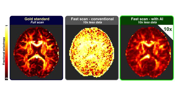A method combines magnetic resonance imaging and simulation-based artificial intelligence to speed up brain analysis