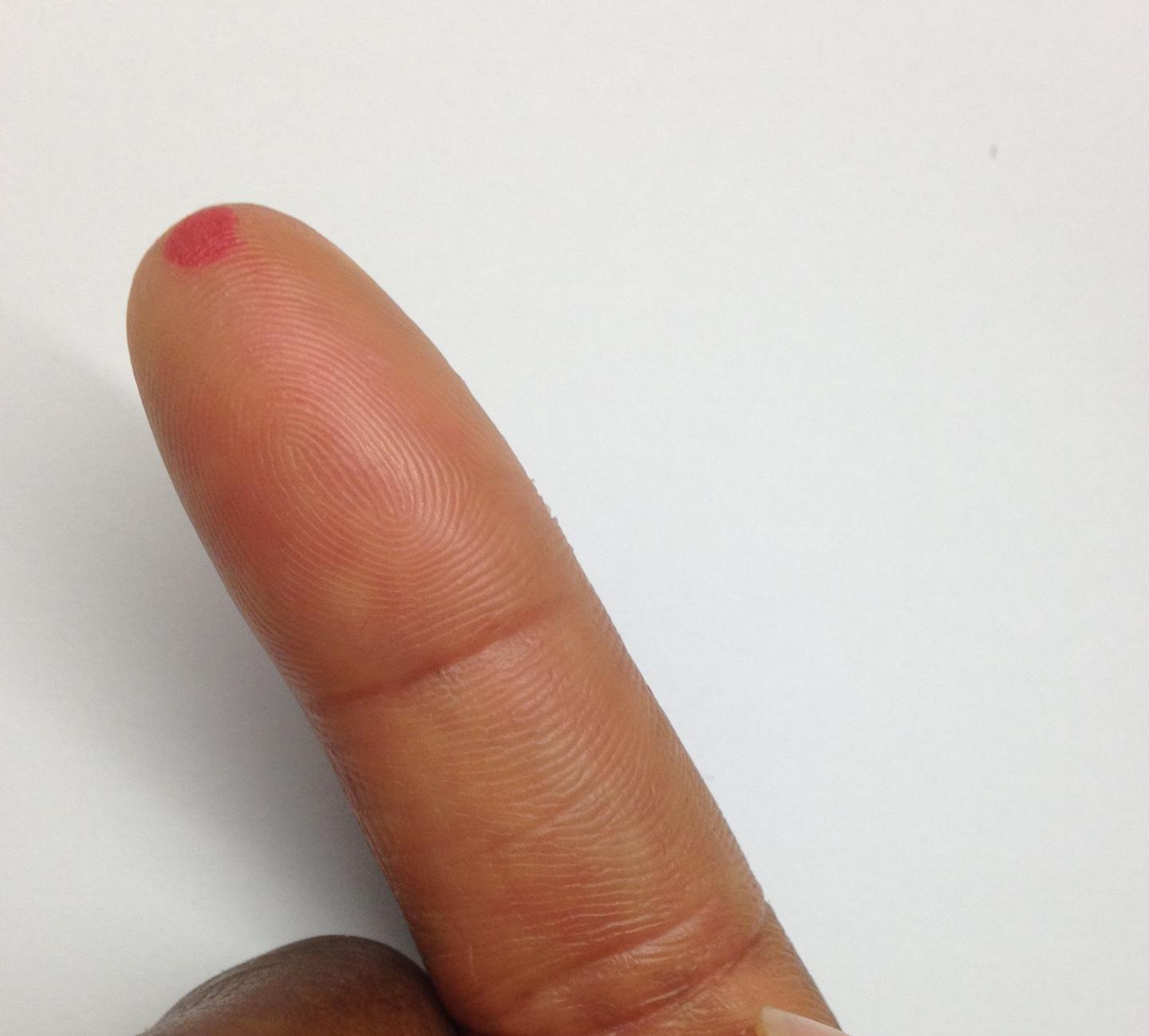 Type 2 Diabetes and OSA