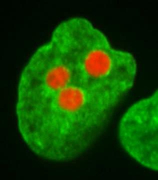 Coalescence of Nucleoli in Human Nucleus