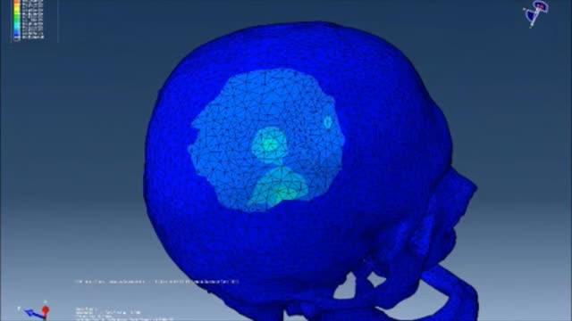 Skull Fractures on Impact