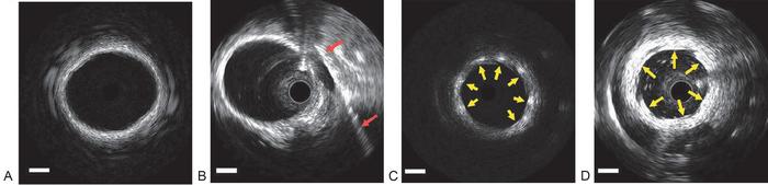 Figure 2Open multimedia modalEx vivo vasculature imaging using AO-IVUS and commercial 40-MHz IVUS