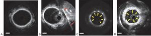 Figure 2Open multimedia modalEx vivo vasculature imaging using AO-IVUS and commercial 40-MHz IVUS