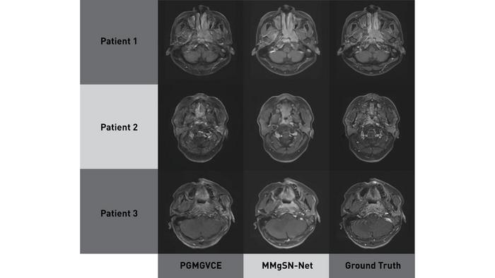 A progressive evolution in virtual MRI imaging for tumour detection
