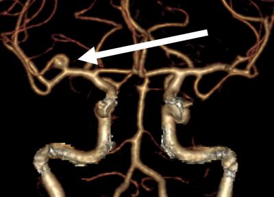 A Brain Aneurysm