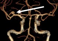 A Brain Aneurysm