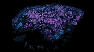 MALAT1 in breast cancer metastasis