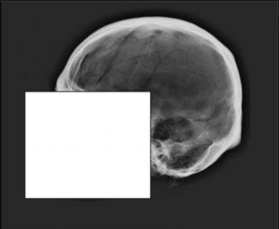 Cranial Vault Outline of the Skull