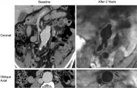 Presence of Blood Clot Associated with Rapid Aortic Aneurysm Growth (3 of 3)