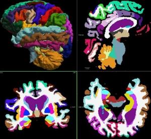 Segmented and labeled images of a normal brain