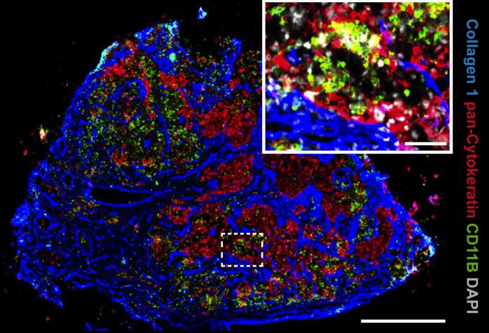 Immunofluorescence of a lymph node metastasis