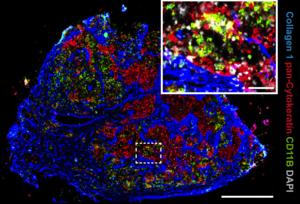 Immunofluorescence of a lymph node metastasis