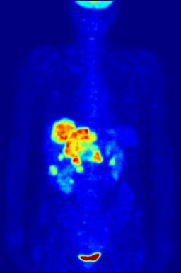 Whole-Body PET Scan