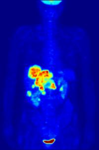 Whole-Body PET Scan
