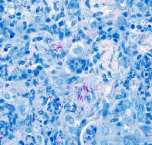 Tuberculosis (TB) bacteria appear in red inside a lung granuloma from a mouse infected with Mycbacterium tuberculosis, the bacterium that causes TB.
