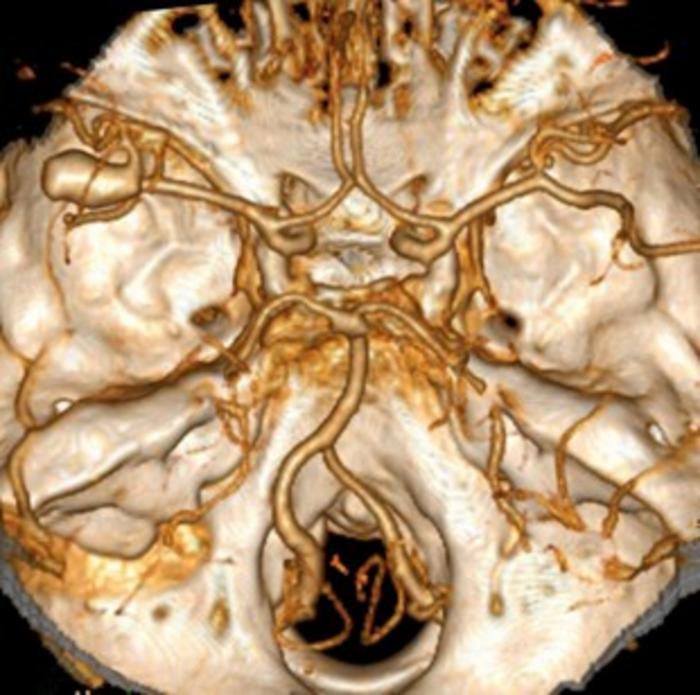 Flow diversion devices are a safe long-term treatment for intracranial aneurysms