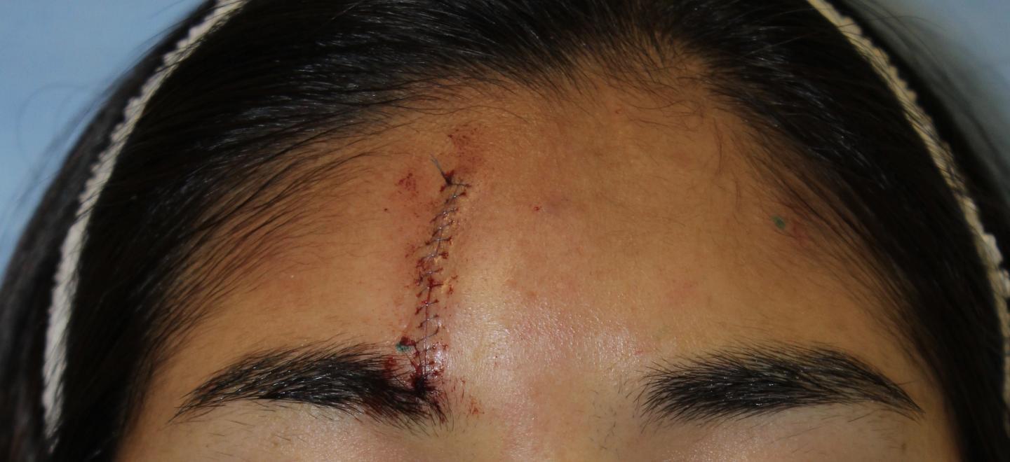 Scar after Surgery