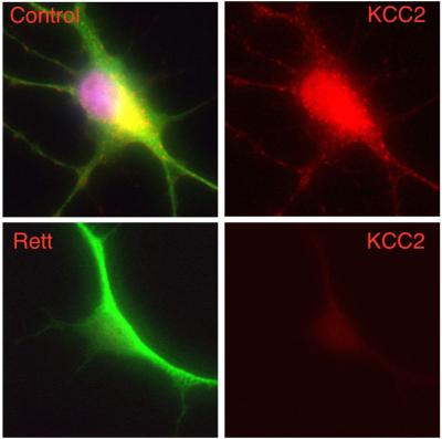 Discovery of a New Drug Target Could Lead to Novel Treatment for Severe Autism