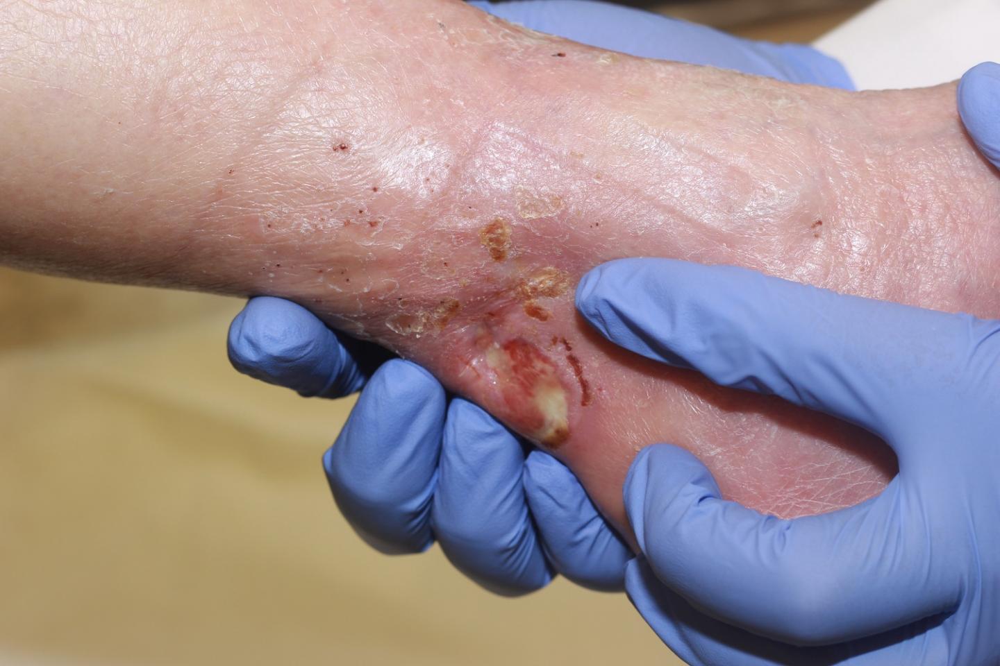 Wound