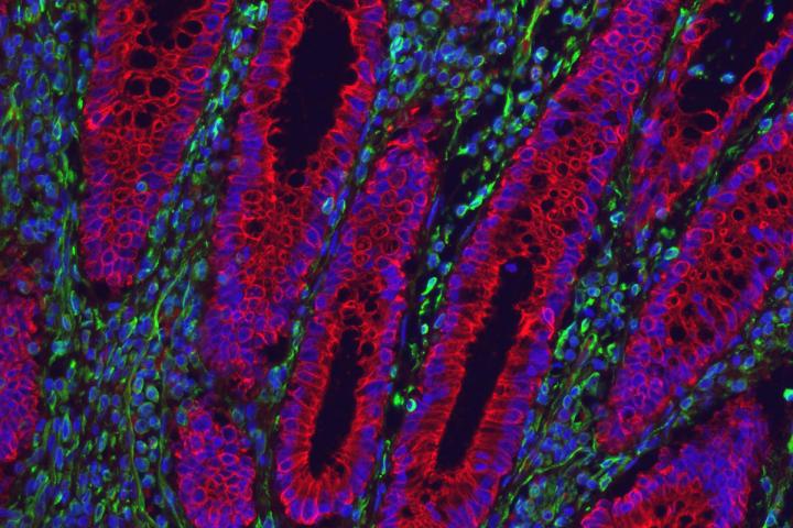 Inflamed Colon