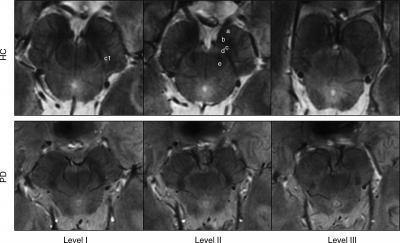 Substantia Nigra Scans (1 of 2)