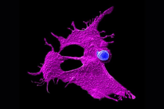 Microscopy image showing a stem cell-engineered CAR-NKT cell (blue) attacking a human solid tumor cell (magenta)