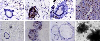 Cell Changes Drive Breast Cancer Relapse