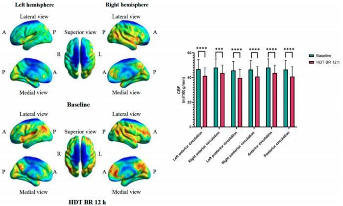 Fig. 2. Changes in cerebral blood flow (CBF) across bilateral anterior and posterior circulations before and after a 12-h –6° head-down tilt (HDT) bed rest (BR).