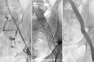 Stent treatment for severe post-thrombotic syndrome