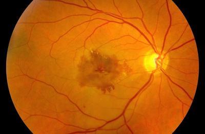 AMD Eye