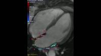 Afib (2 of 2)