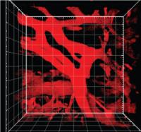 Blood Vessels around a Pancreatic Tumor Become Leakier in the Presence of Fasudil