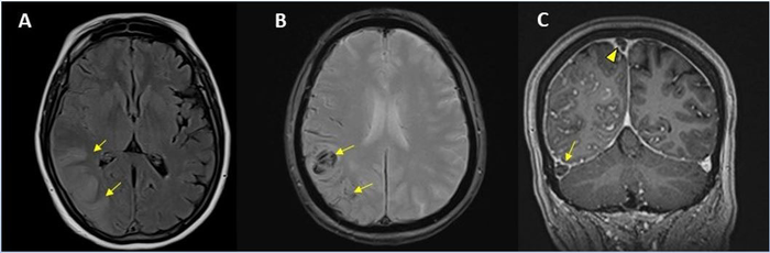 Large International Study Reveals Spectrum of COVID-19 Brain Complications