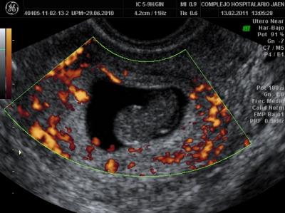 Abortion