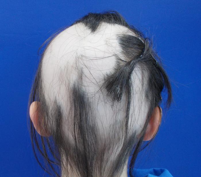 Alopecia Areata case