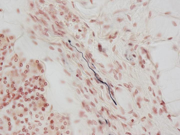 Researchers Identify Tissue Biomarker for Dementia with Lewy Bodies and Parkinson's Disease
