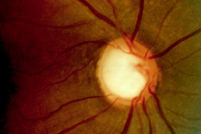Glaucoma