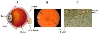 Age-Related Macular Degeneration