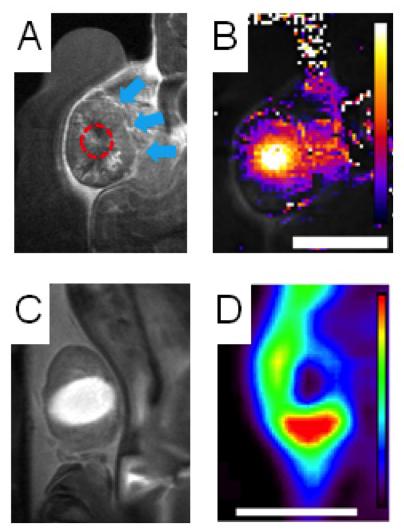 Ultrasound Plus Nanoparticle Chemo Destroys Tumors in Mice