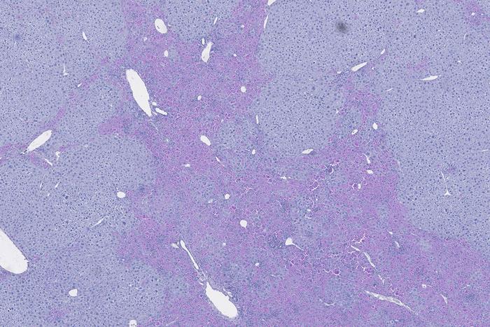 New clues to disease severity identified in alpha1-antitrypsin deficiency