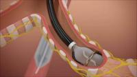 Catheter