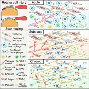 Single-cell atlas reveals fibrotic drivers of rotator cuff scar formation